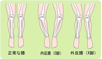 「膝の変形」の画像検索結果