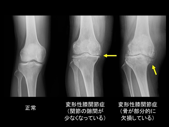 変形 性 膝 関節 症