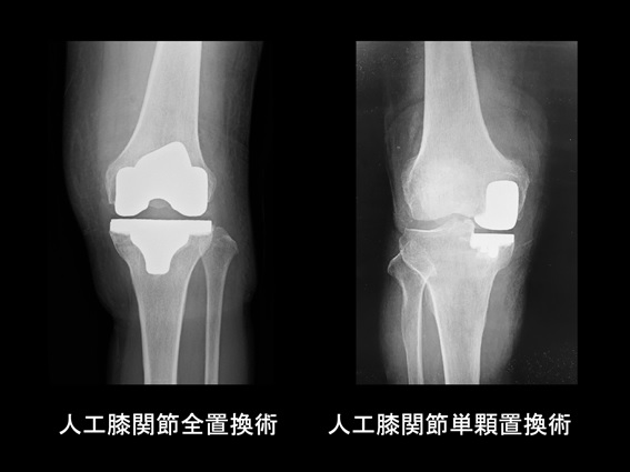 術 関節 人工 膝 置換 人工膝関節置換術とは