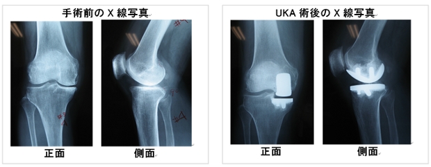 第18回 『人工膝単顆置換術＝UKAとは』｜関節の広場 -いつまでも、歩き 