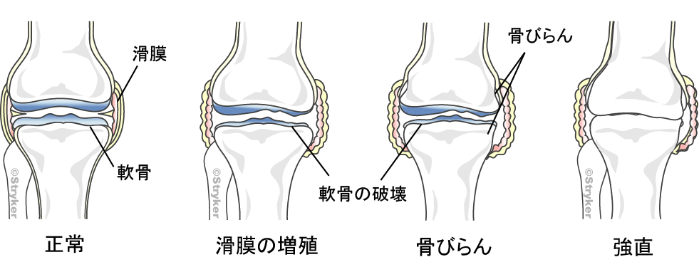 リウマチひざ変形改訂