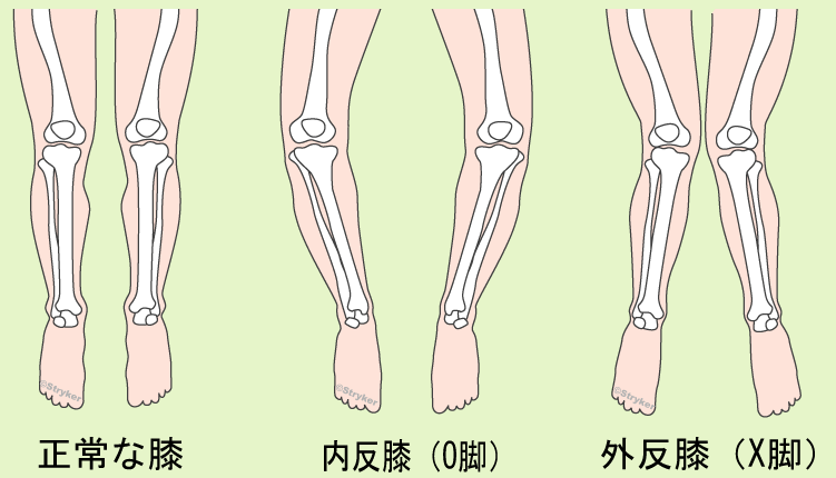 両足変形膝 背景ありc2