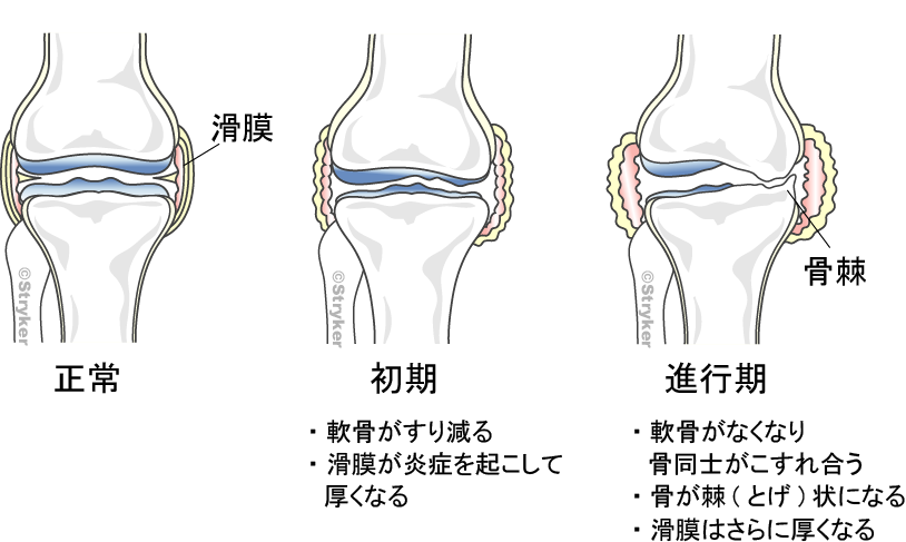 変形性ひざ関節症進行 背景ありc2