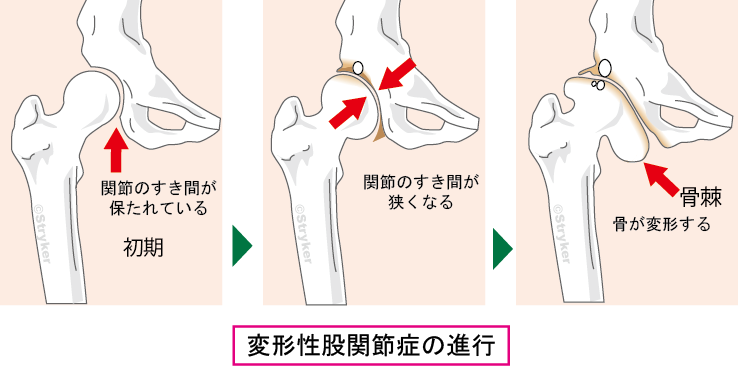 変形性股関節症_文字有ｃ