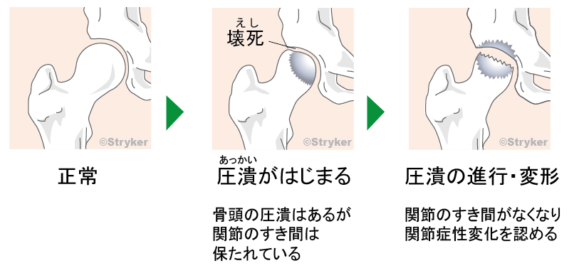 大腿骨頭壊死症2c