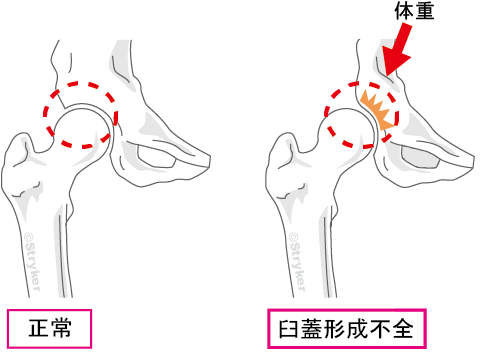 臼蓋形成不全_文字有c